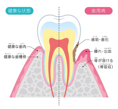 歯周病